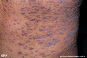 lichen planus