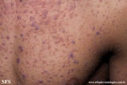 lichen planus