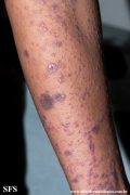 lichen planus
