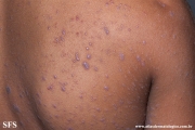 lichen planus