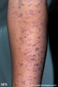 lichen planus