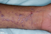 lichen planus