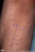 lichen planus