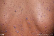 lichen planus