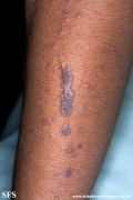 lichen planus