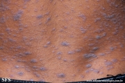 lichen planus