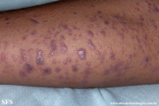 lichen planus