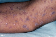 lichen planus