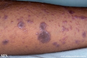 lichen planus