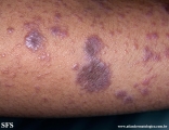 lichen planus