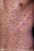 lichen planus