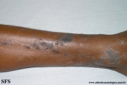 lichen planus