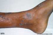 lichen planus