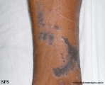 lichen planus