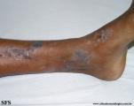 lichen planus