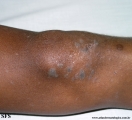 lichen planus
