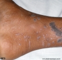 lichen planus