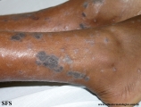 lichen planus