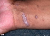 lichen planus