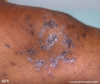 lichen planus
