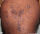 lichen planus