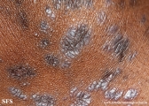lichen planus