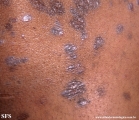 lichen planus