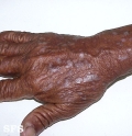 lichen planus
