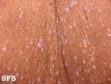 lichen planus