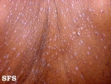 lichen planus