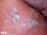 lichen planus