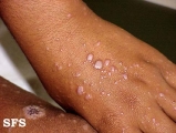 lichen planus