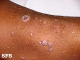 lichen planus