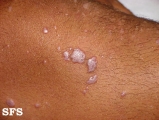 lichen planus