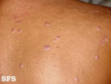 lichen planus