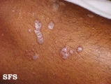 lichen planus