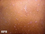 lichen planus