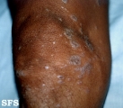lichen planus