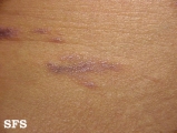 lichen planus
