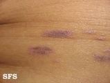 lichen planus