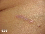 lichen planus