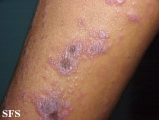 lichen planus