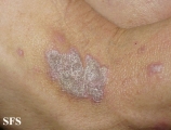 lichen planus