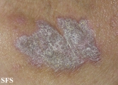 lichen planus