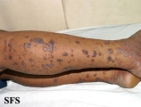 lichen planus