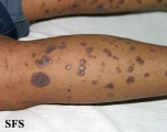 lichen planus