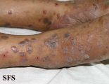 lichen planus