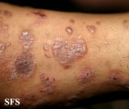 lichen planus