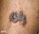 lichen planus