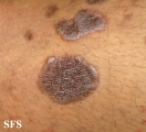 lichen planus